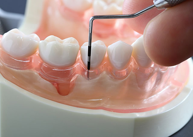 レントゲン、歯周組織検査